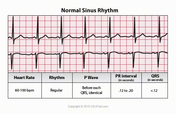 normal sinus rhythm