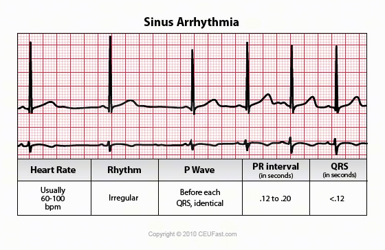 Sinus Rhythm Chart