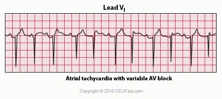 EKG, ECG Interpretation Course | CEUfast Nursing Continuing Education