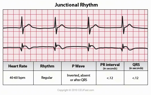 junctional escape rhythm strip