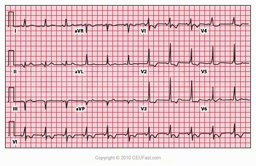 wolff parkinson white syndrome