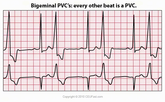 bigeminal pvc