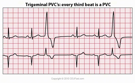 trigeminal pvc