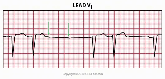 EKG, ECG Interpretation Course | CEUfast Nursing Continuing Education