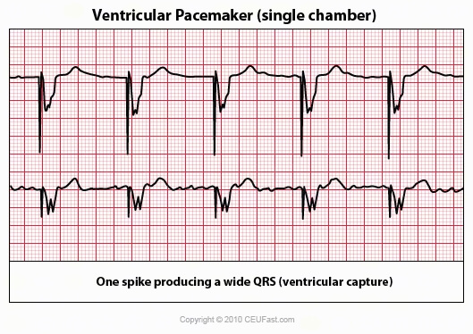 ventricular pacemaker