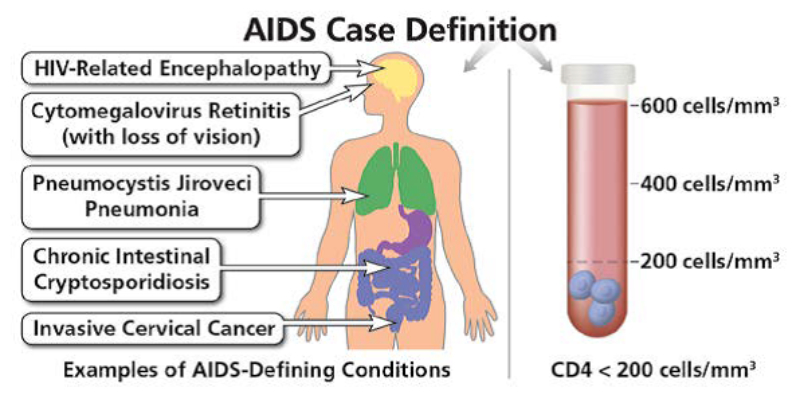 graphic showing AIDs case definition