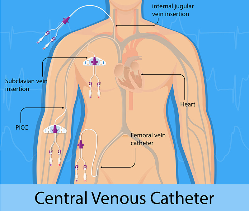 triple lumen central line proximal distal medial