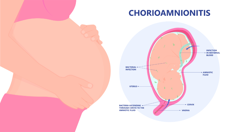 graphic showing chorioamnionitis