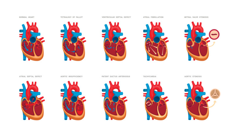 graphic showing types of congenital heart defects are found in children