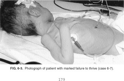 Patient marked failure to thrive