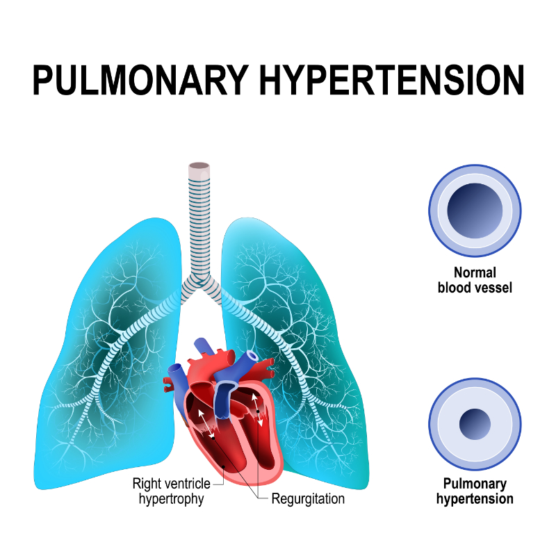graphic showing pulmonary hypertension