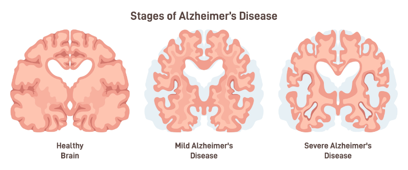 graphic showing health vs alzheimers brain