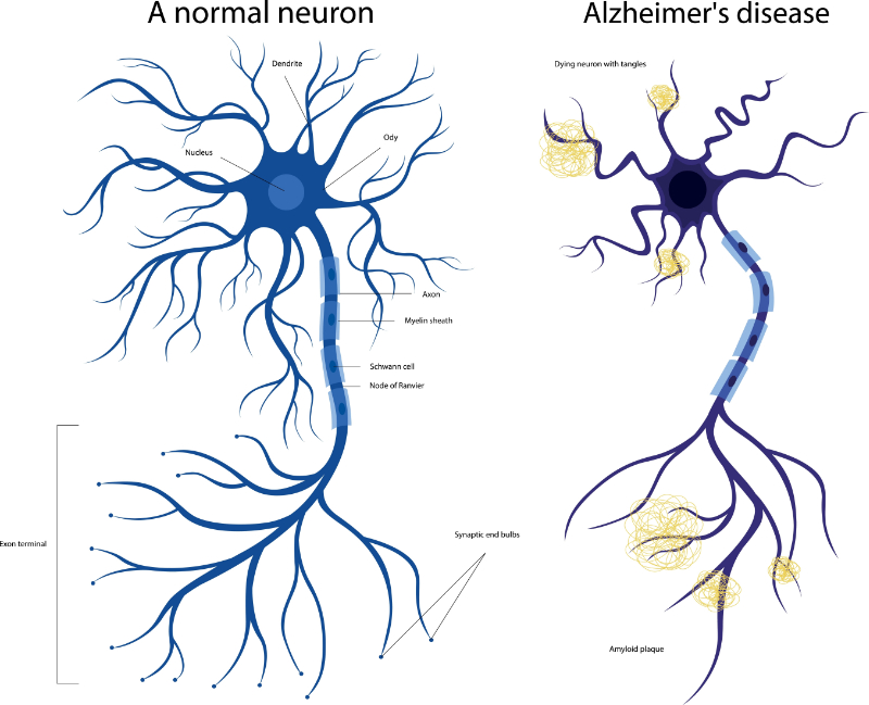 graphic showing health vs diseased neuron