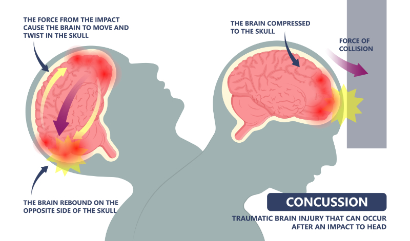 graphic showing concussion and labeled issues