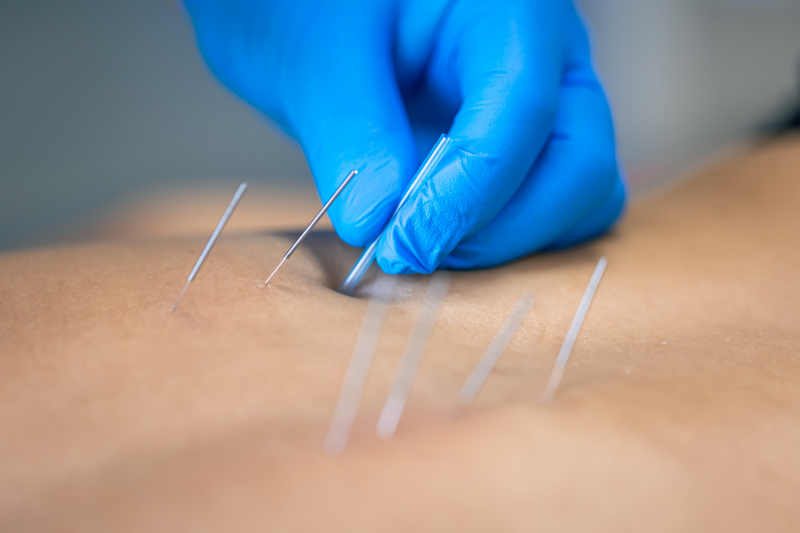 photo of dry needling