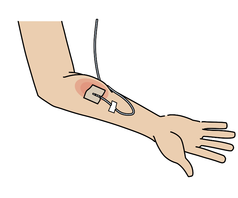 graphic showing extravasation 