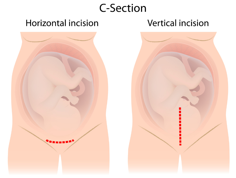 graphic showing horizontal vs vertical c-section incisions