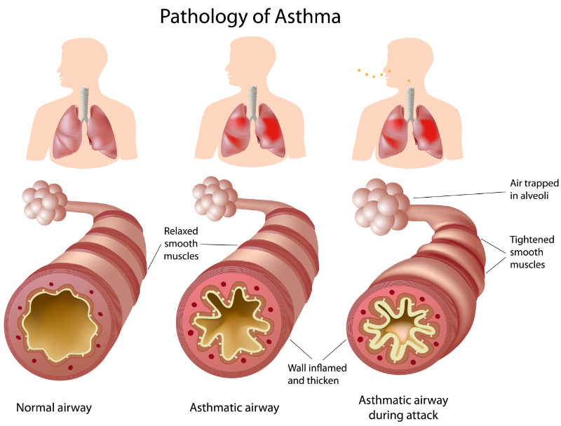 graphic showing pathology of asthma