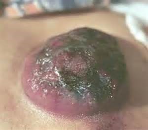 image of tumor