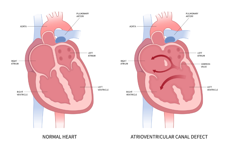 graphic showing atrioventricular canal defect