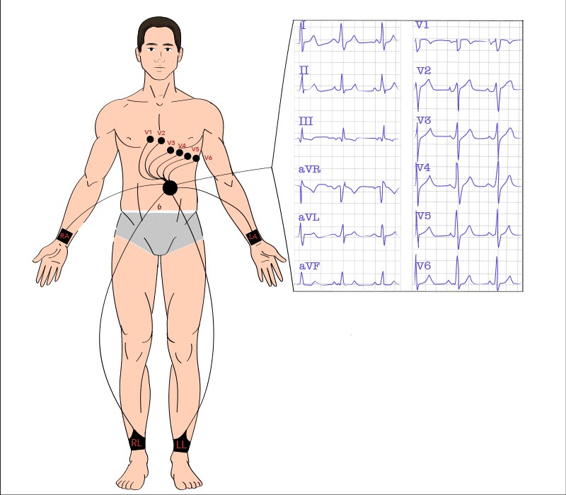 graphic showing standard 12 lead setup