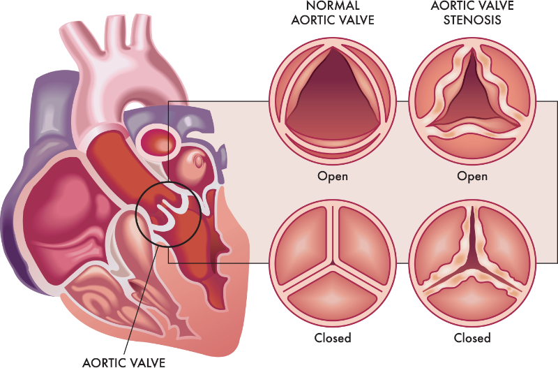 graphic showing aortic stenosis