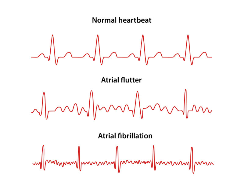 image of ekg and ecg examples