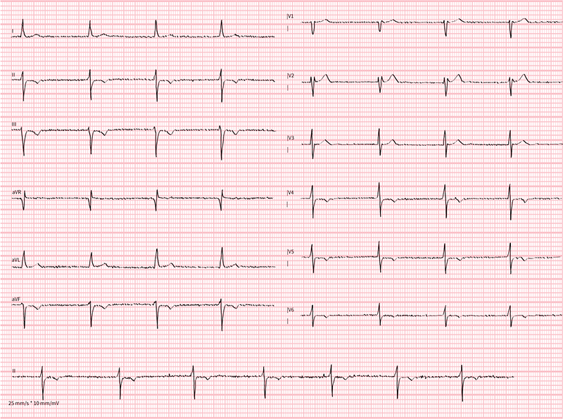 case study ekg-ecg