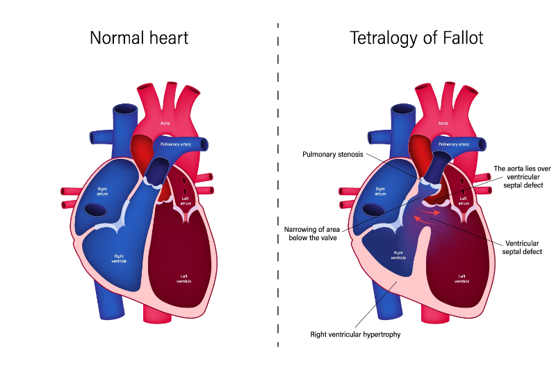 graphic showing tetralogy of fallot