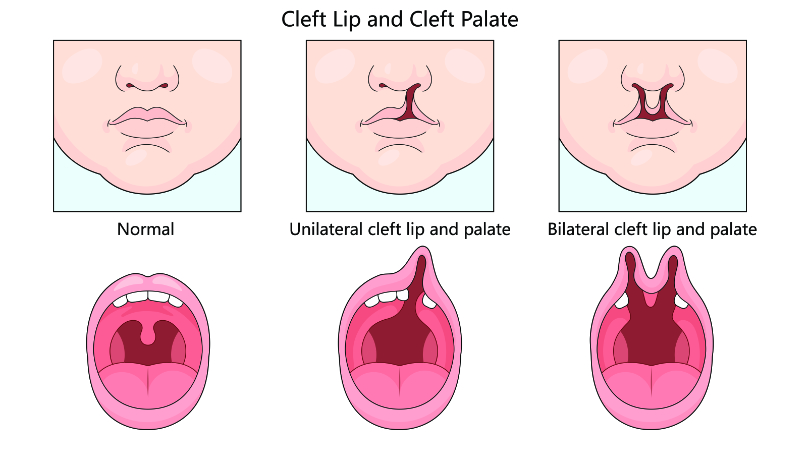 graphic showing cleft lip and cleft palate 