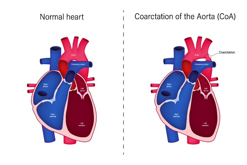 graphic showing coarctation of the aorta