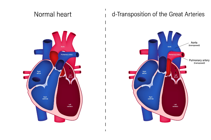 graphic showing transposition of the great arteries