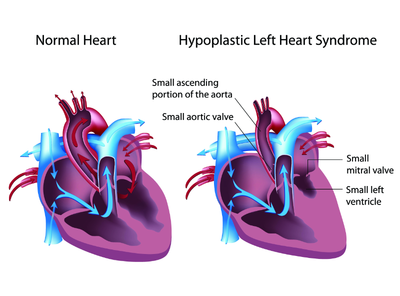 graphic showing hypoplastic left heart syndrome