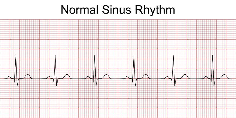 graphic showing normal sinus rhythm