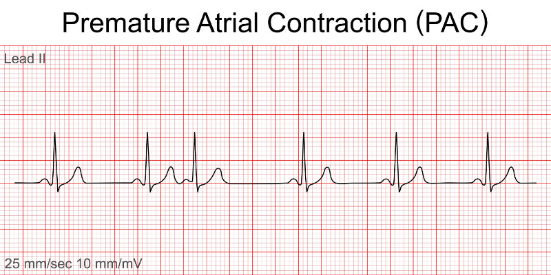 graphic showing premature atrial contraction