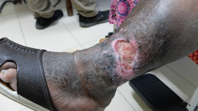 photo of chronic venous insufficiency ulcer