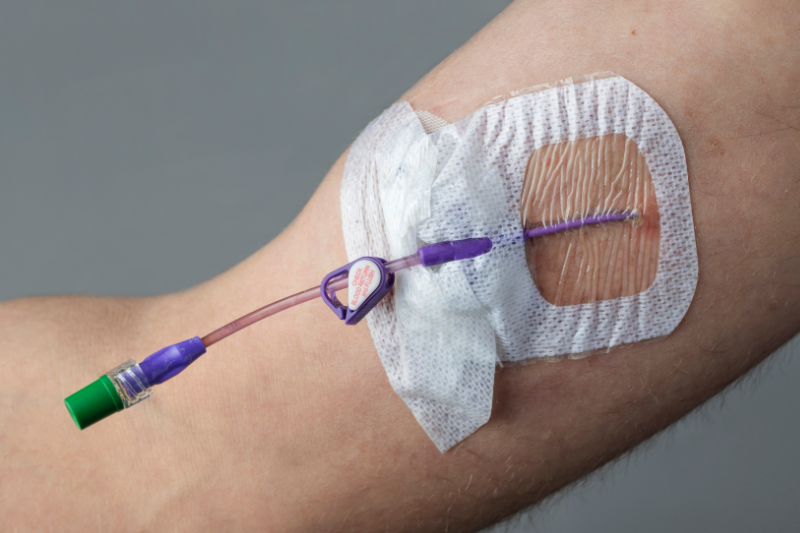photo of a picc line in arm