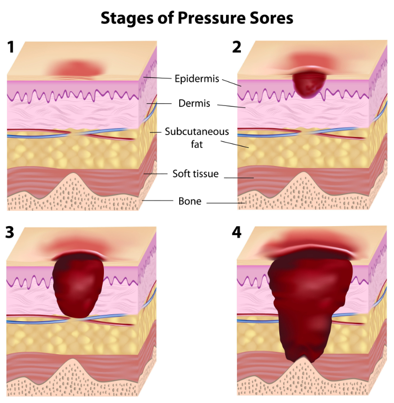 graphic showing states of pressure sores