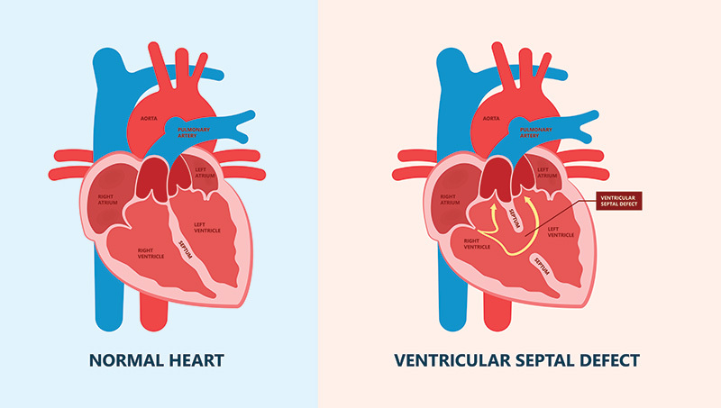 graphic showing ventricular septal defect