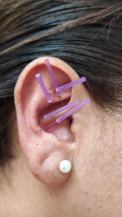 photo of auricular acupuncture