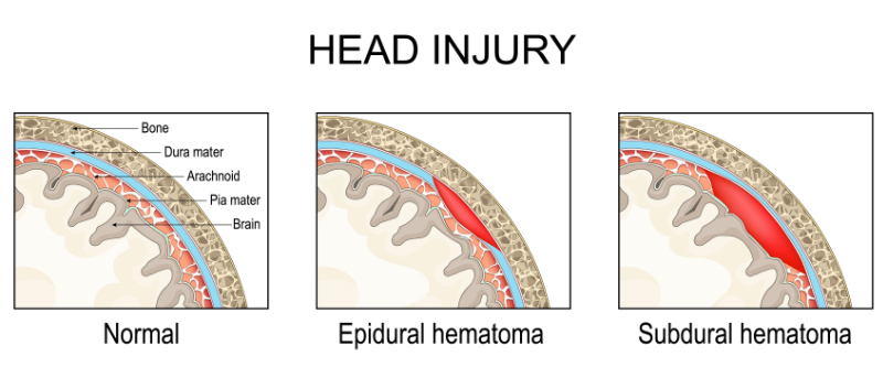 graphic showing intracranial hematomas