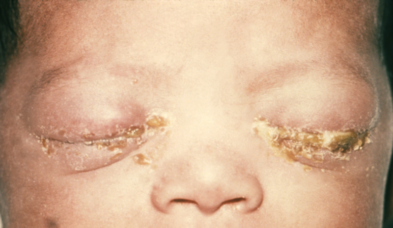 photo showing infant neonatal gonococcal opthalmia