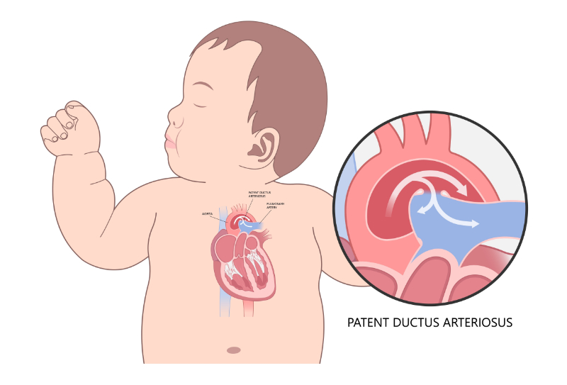 graphic showing patent ductus arteriosus