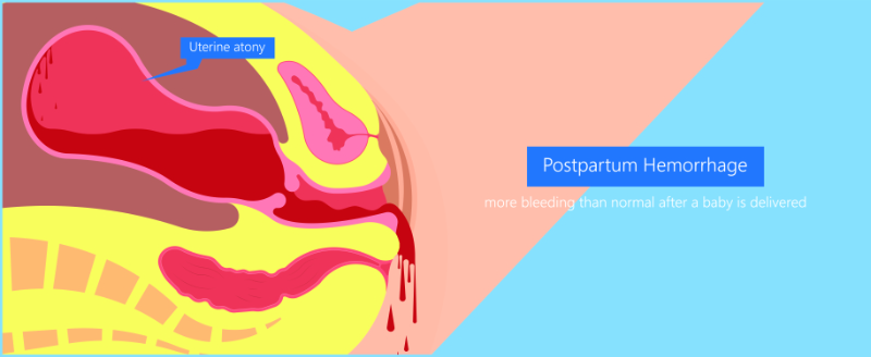 graphic showing postpartum hemorrhage