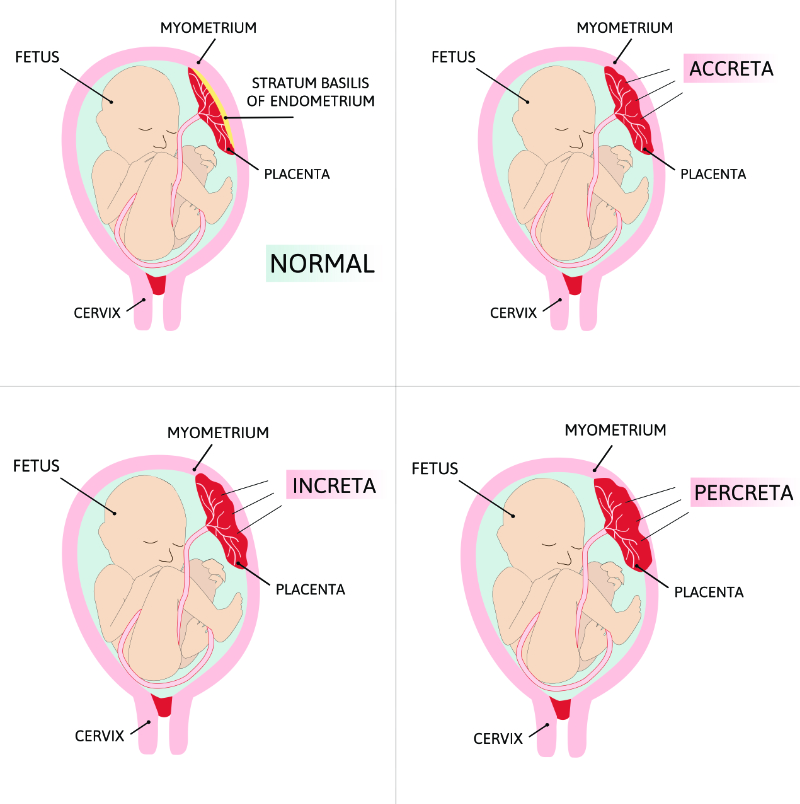 graphic showing four types of placenta accreta