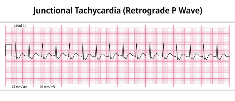 image of junctional tachycardia