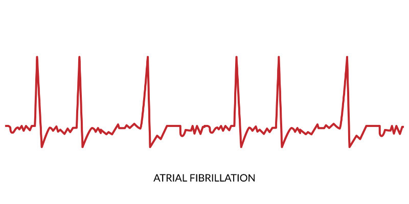 image of afib