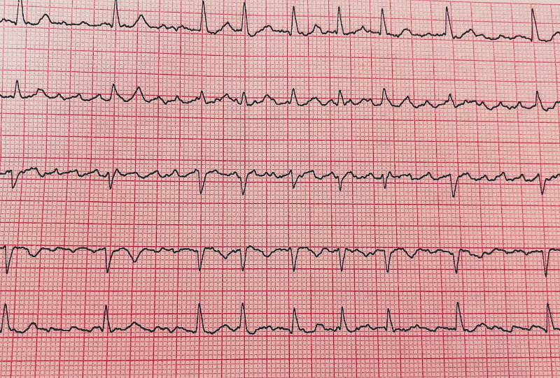 image of afib ekg