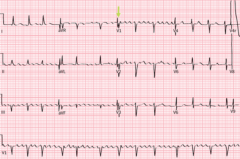 image of atrial flutter