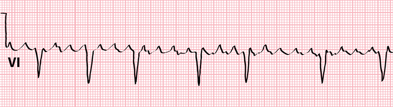 image of atrial flutter with variable conduction